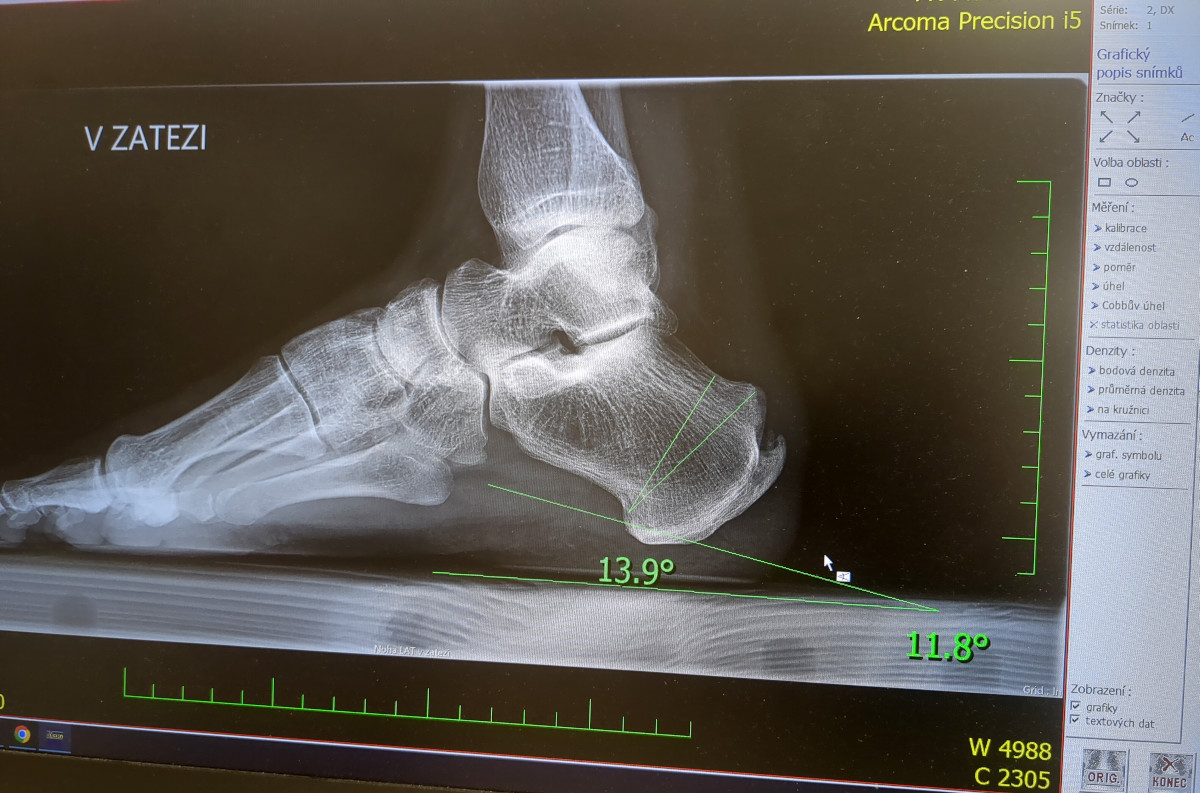 rentgen se sklonem kosti a záznamem vyříznutí klínu